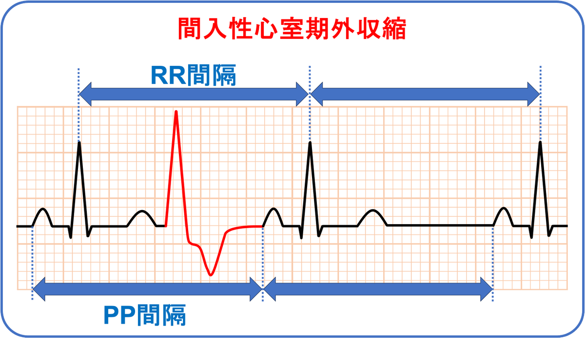 間入性心室期外収縮は洞調律の周期に影響を与えないため、基本的にPP間隔・RR間隔は同じになります。