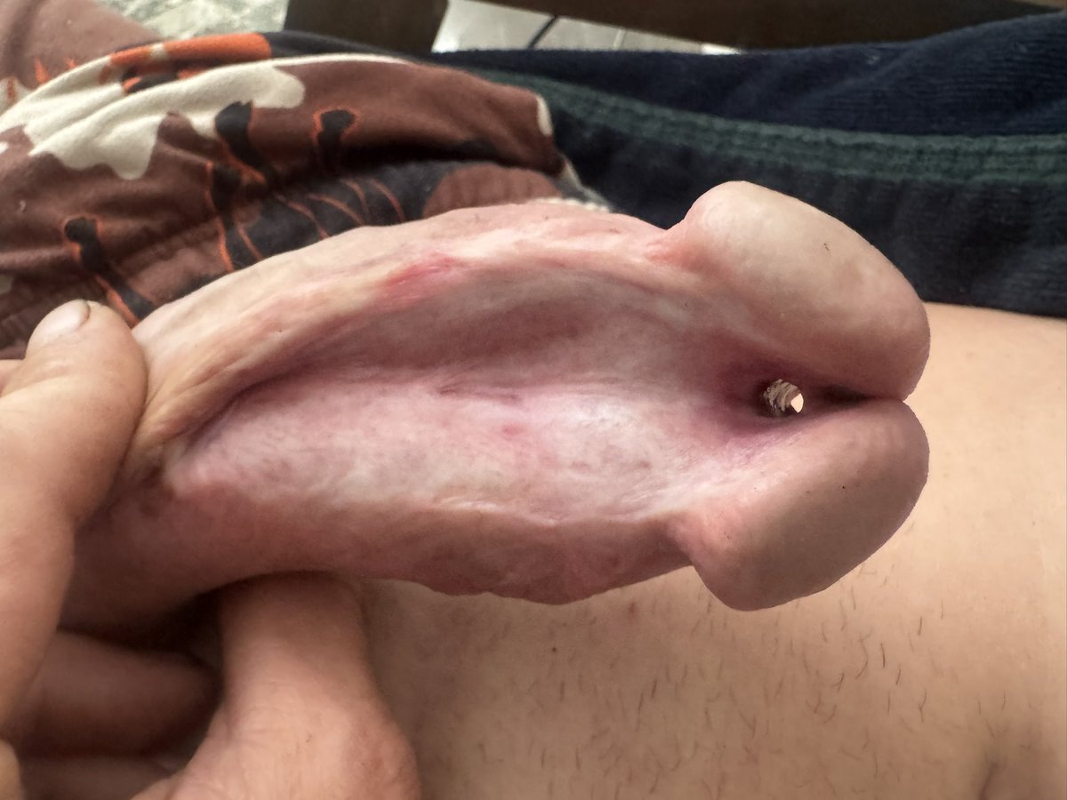 thickcanucksub's tweet photo. 5mm RPA apadravya subincision #cockmods #cockpiercing #subincision  #apadravya #rpa https://t.co/uqoepiLRse