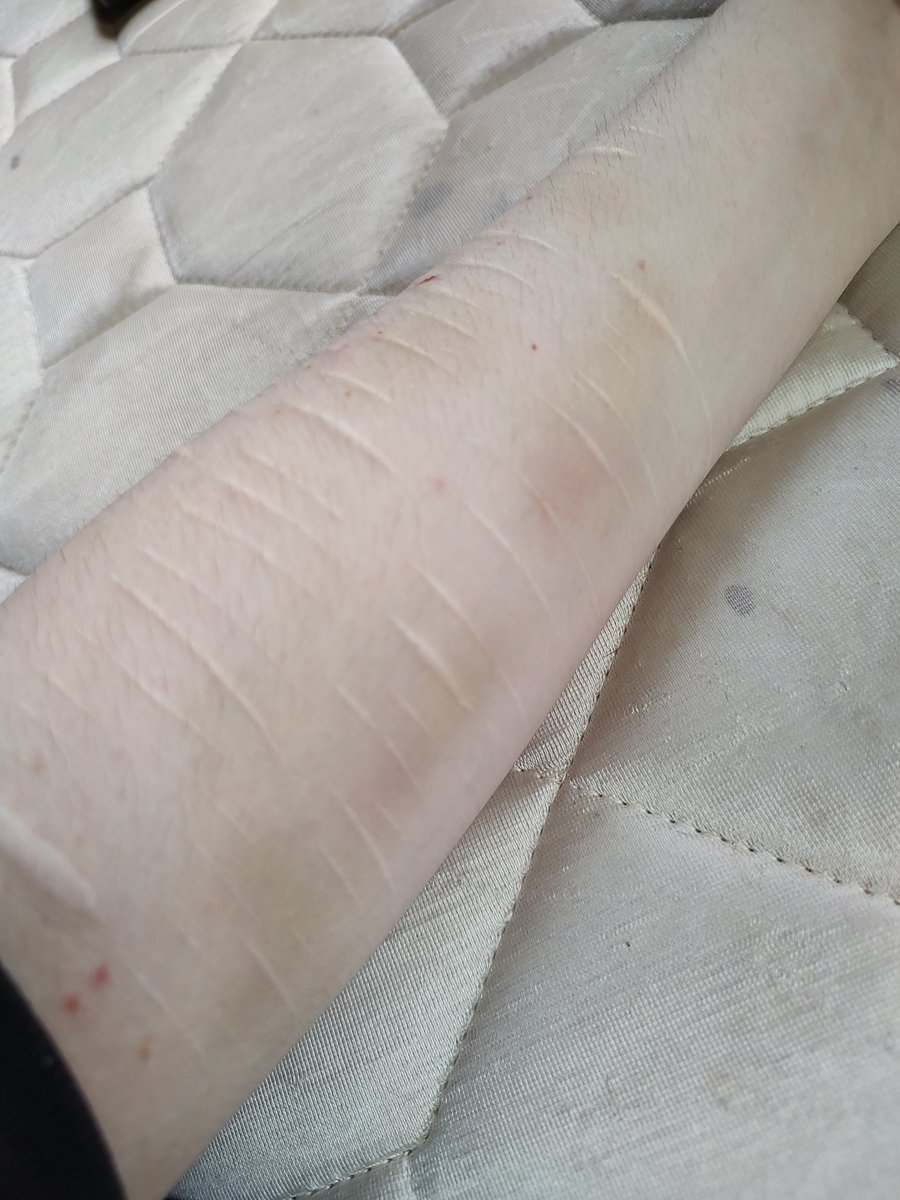 throwaway69gg's tweet photo. #shtwt buncha bruises https://t.co/W6afgNgNgG