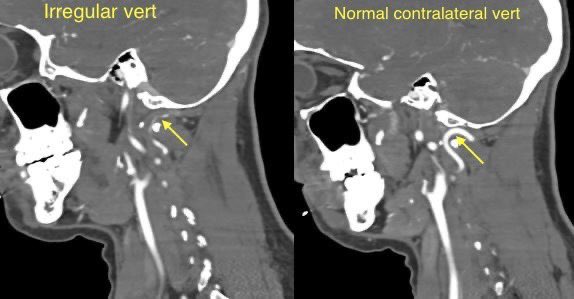 daniel_gewolb's tweet photo. PREcontrast T1 weighted images w/ fat suppression can improve detection of arterial dissection when CTA is equivocal

Case example in 🧵

#Neurology #neurosurgery #MedEd #medicine #radres #futureradres @ASHNRSociety @Radiopaedia https://t.co/0VmHt6ENjq
