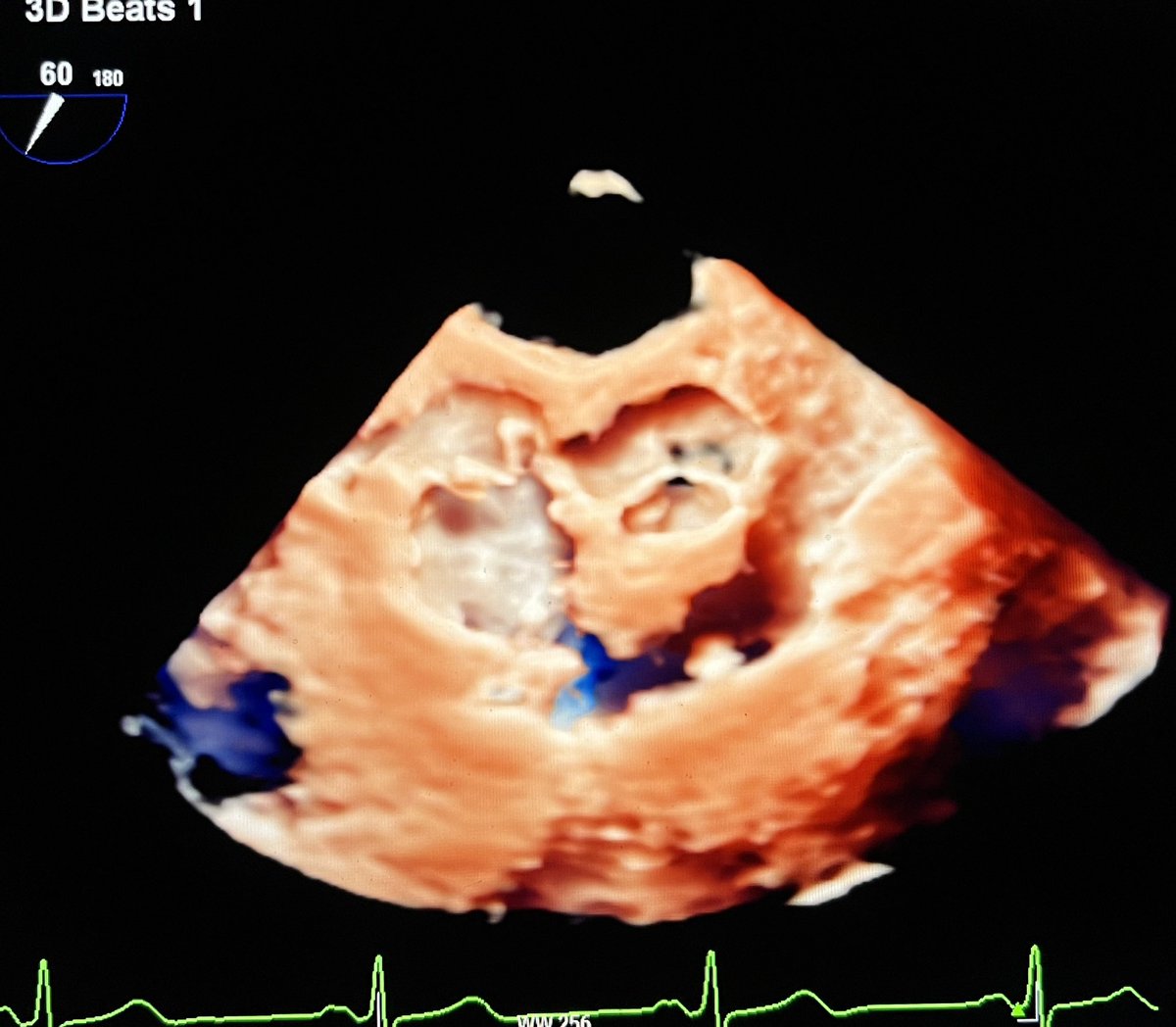 CASivaram1's tweet photo. #echofirst
☑️ Well known right atrial vestigial structure- Eustachian valve
☑️ Located at the junction of IVC-RA
☑️ Long & mobile example ⬇️
☑️ Might be mistaken for thrombus or vegetation
☑️ Directs blood flow from IVC to IAS during fetal life
☑️ Might play a role in paradoxical embolism
@swatigar 
@OungSavly 
@alex1708ander 
@DrRajeshG1 
@HeartOTXHeartMD 
@JohnHenryDean 
@sudarshanballa 
@iamritu 
@NadeenFaza 
@argulian 
@ZainAsadCardOnc