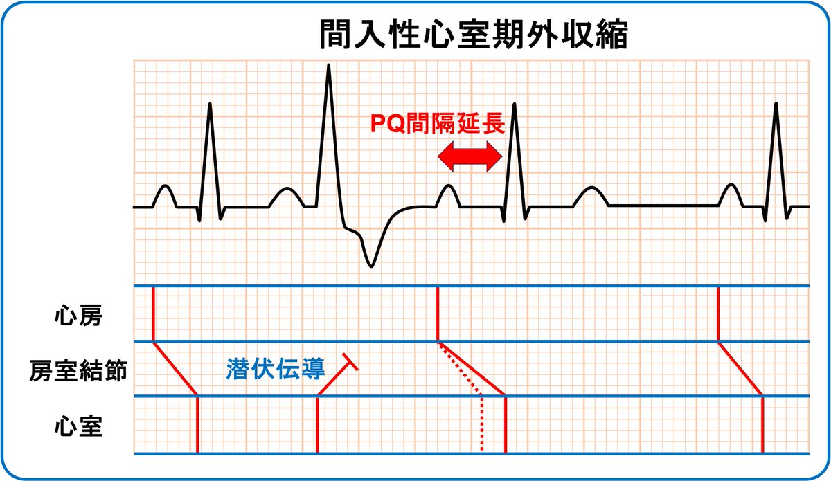 間入性心室期外収縮では逆行性伝導による刺激伝導系の不応期から回復する時間が不十分であり、洞結節からの興奮が房室結節の相対不応期の間に伝わると伝導遅延が生じることでPQ間隔延長をきたすことがあります。