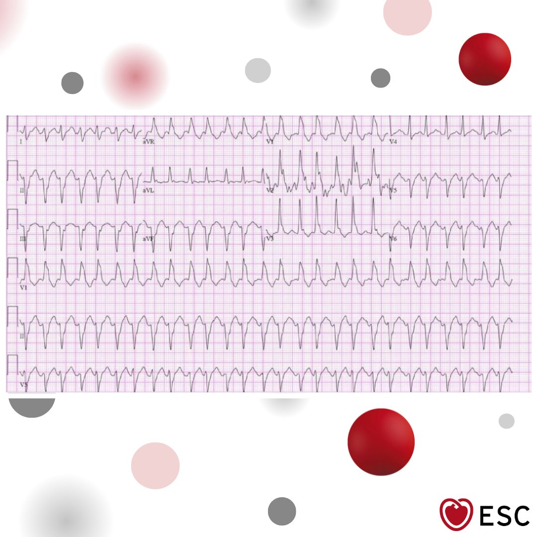 escardio's tweet image. #ImageOfTheWeek by Anish Adhikari and Caleb Wutawunashe from Lenox Hill Hospital/Northwell Health, New York, New York, USA.

What is the preferred drug for this ventricular tachycardia? ow.ly/xntH50WF4Jp

#cardioed