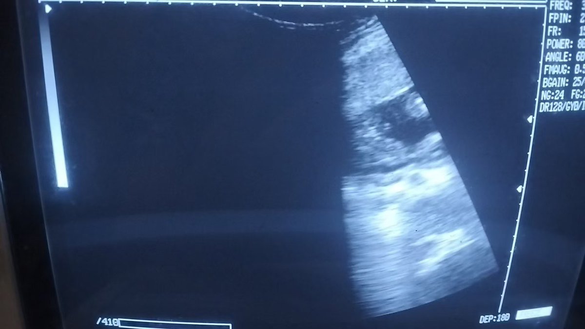 【#移植成功 大惊喜 #龙凤胎】
✨意不意外？惊不惊喜？
这份‘双份满分答卷’早就是成竹在胸啦！🎋  感恩所有信任，未来也要一起见证萌娃们的成长呀～❤️"
咨询微信：a18025307951
#HIV生子 #三代代孕 #失独代孕 #二代代孕 #洗精代孕 #三代包成功 #夫妻代孕 
#试管婴儿 #试管助孕 #代孕 #广州代孕