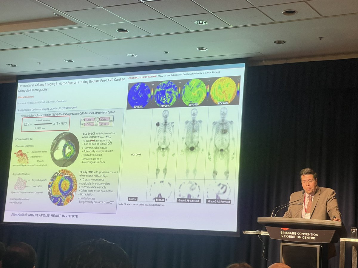 Dr. Joao Cavalcante (<a href="/JoaoLCavalcante/">João Cavalcante</a>) at #CSANZ2025 on
🖥️ CT ECV quantification during routine pre-TAVR
🧩 Detecting fibrosis &amp; amyloid in severe AS
📊 Multi-modality synergy
<a href="/thecsanz/">CSANZ</a> @SCCT <a href="/SCMRorg/">Society for Cardiovascular Magnetic Resonance</a>