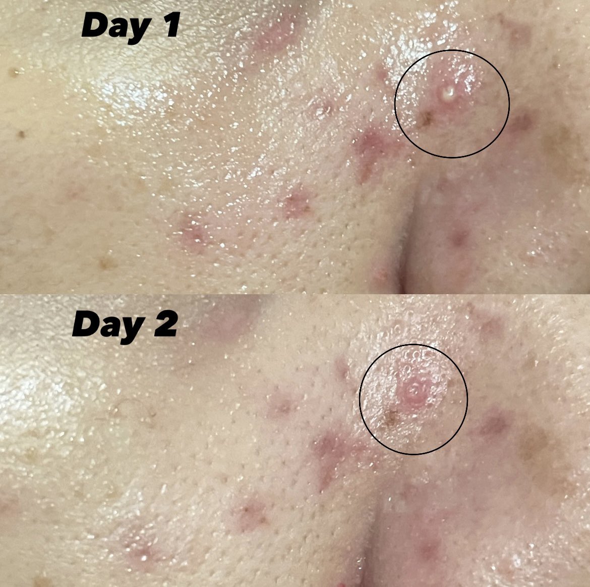 Senenggggg bgttt !!!! Demii apaaa !!??? Jerawat pustul (bernanah) bisa kempess dan kalem cuma dalam semalam aja. Woylah,,,, kaum acne prone mesti tau inii 🫵🏻