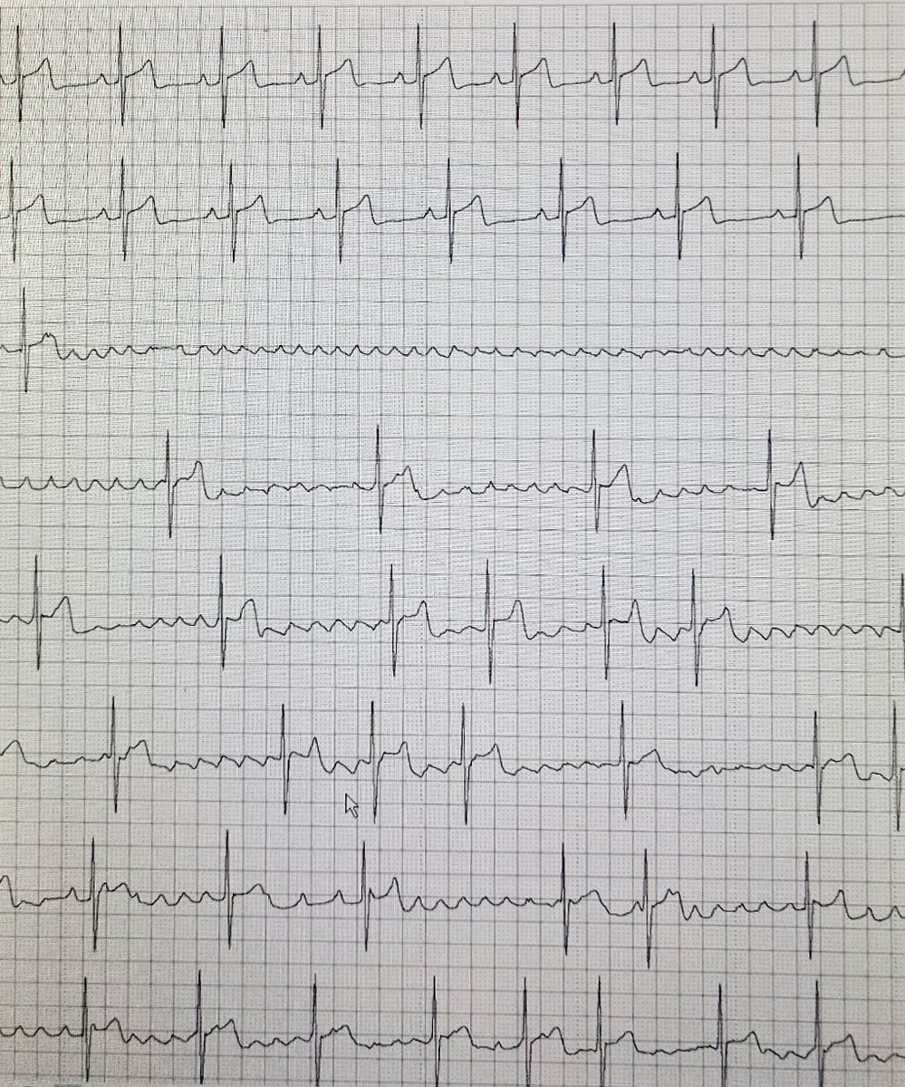 Anyone observed an “Initiation pause” at start of AF? #EPeeps love physiology! 

PVI, CNA or both? RF or PFA? 👇