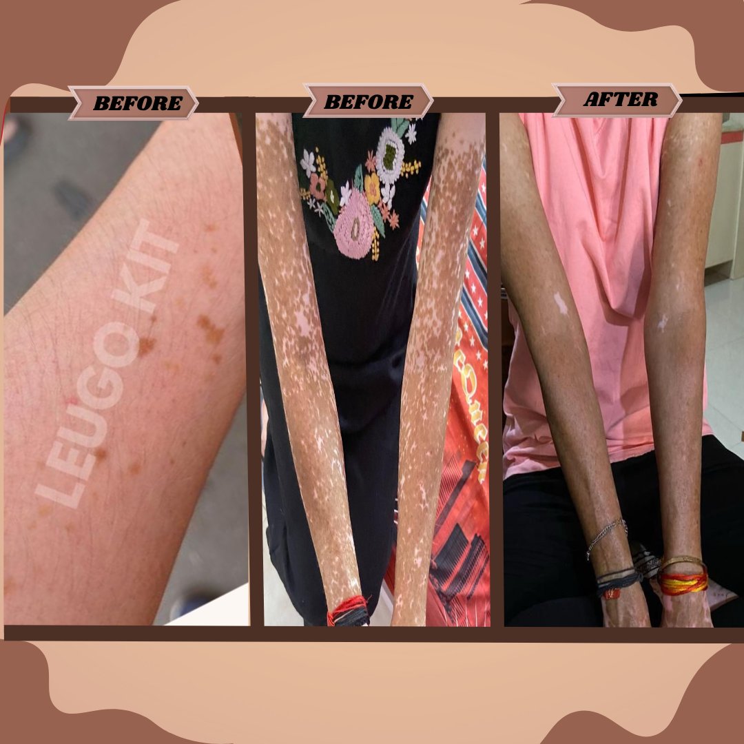 forestveda1's tweet photo. 🟢 90% से ज़्यादा राहत — सिर्फ Leugo Kit से!
 ये सब Old Forest Ayurveda के Guarantee Card के साथ संभव हुआ।
📸 Real Result | 💯 100% Ayurvedic
📄 Guarantee Card से इलाज का भरोसा
✅ 100% Ayurvedic | बिना साइड इफेक्ट
📞 संपर्क करें : 8657870870
📷 Visit us: https://t.co/uGeTjGi97D https://t.co/9rOVXqGfin