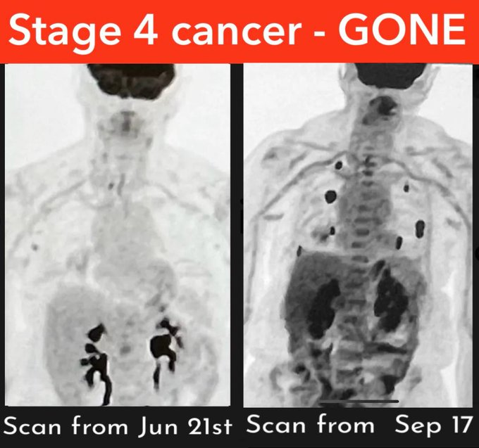 **Don't tell Pfizer**

‼️  73-yr-old woman beats Stage 4 CANCER Naturally!

Doctors tell her there's No hope for a cure.

But just 3 months later, scan reveals No Disease! 

What she did:

Her son did research on X, came across my posts suggesting IP6 (Inositol Hexaphosphate),