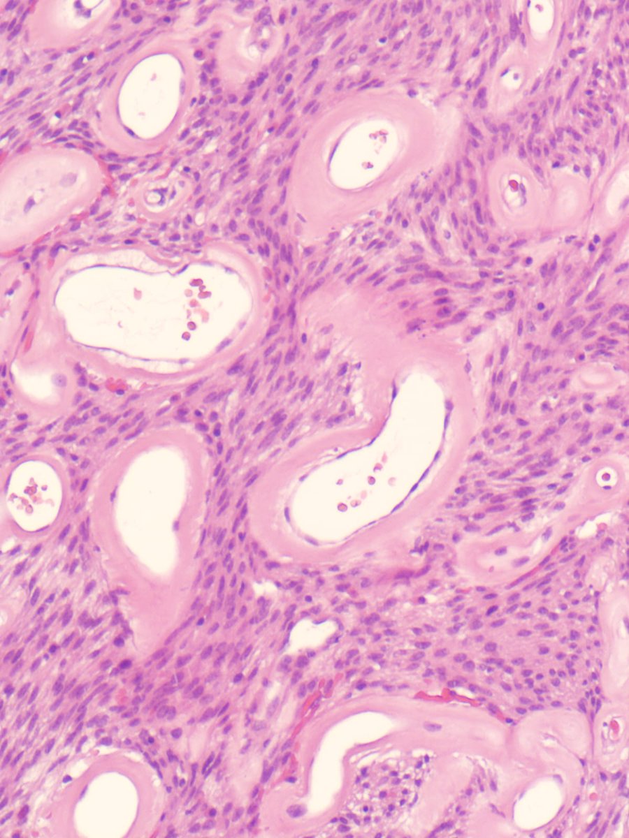 A 70 year old gentleman presented with right sided nasal obstruction and nasal discharge, was found to have a 5 cm right nasal mass. 
Excision of the mass was performed. 
What is your opinion?
#ENTpath
#Headneckpath
#Pathtwitter 
#PathX