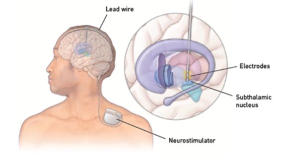 drsujoysanyal's tweet photo. Deep Brain Stimulation (DBS) in Kolkata: A Hope for Advanced Parkinson's Patients https://t.co/KtYoYmOwof
#lifeafterdbs #sucessofdbs #brainpacemaker #canditateofdbs #dbskolkata #dbsforadvancedparkinsonsdisease #leadingdbssurgeon #neurosurgeon #neurosurgery #brainsurgeon #DBS https://t.co/OPCI8AkdZy