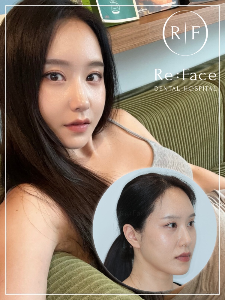両顎手術＋輪郭3点 術後1ヶ月の患者様

Re:Faceの両顎手術は、
プレートも、ピンも、
そして「手術方法そのもの」も──
すべてがオーダーメイドです。

骨の状態、神経線の位置、関節の強度……
患者様それぞれの条件にあわせて、
Multi-Piece方式や片側ずつ異なる術式