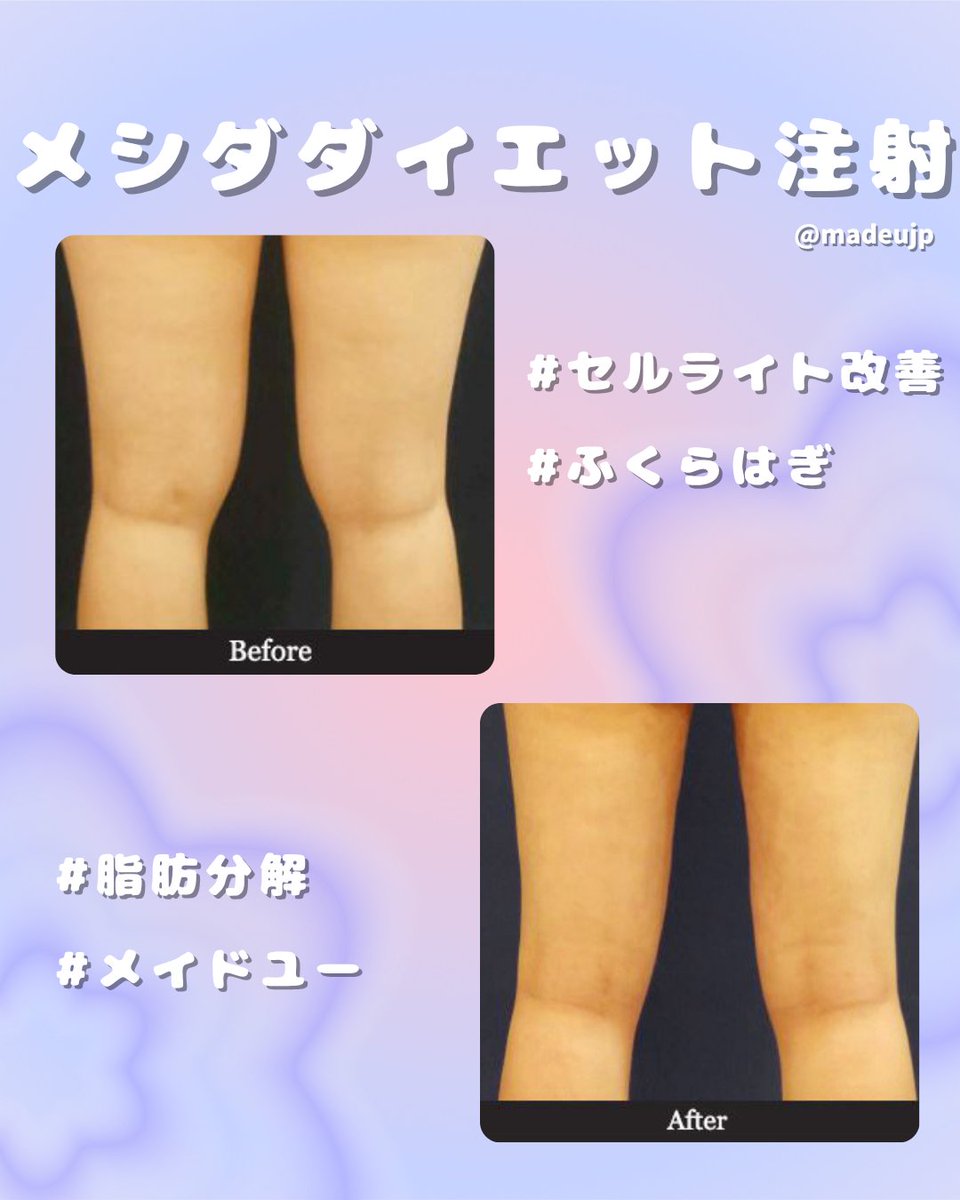 💉メシダ注射ビフォーアフター💉 「なかなか脚痩せできない…」 そんな
