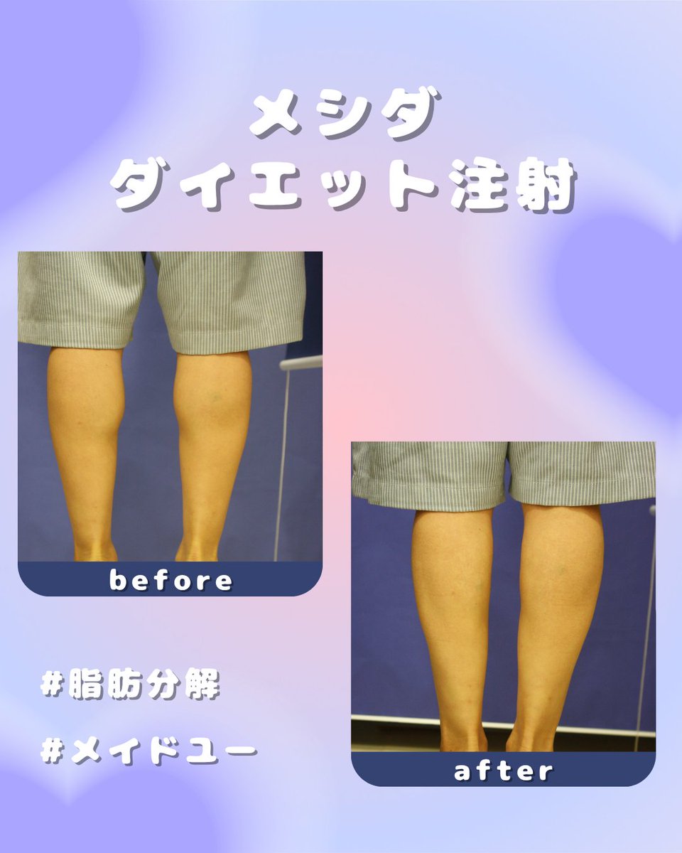 💉メシダ注射ビフォーアフター💉 「なかなか脚痩せできない…」 そんな