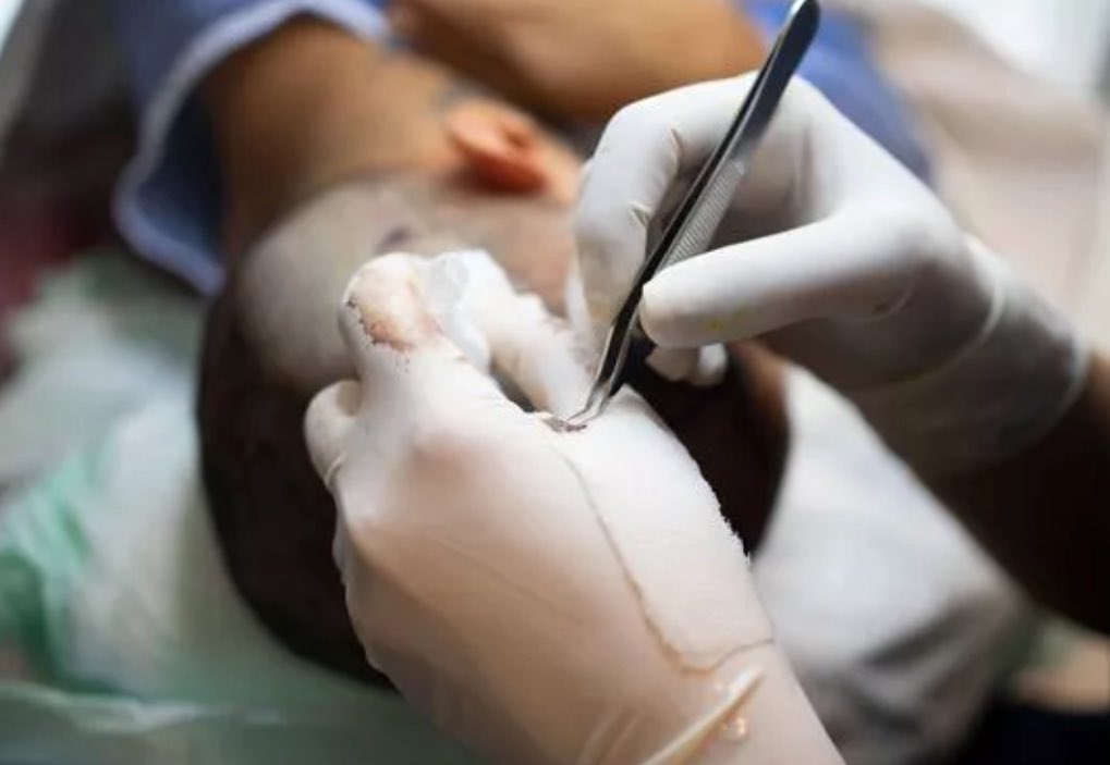 The Turkish clinic that treated a British man who died following a hair transplant procedure insists it undertook all the necessary medical evaluations and tests mirror.co.uk/news/world-new… #hairtransplantsurgery #WhoMakesTheCut #DecisionsBeforeIncisions #hairlossawarenessmonth