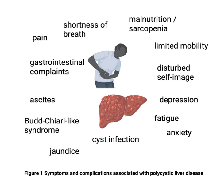 NDTsocial's tweet photo. KDIGO 2025 ADPKD Guideline: 

A commentary on diagnosis and management of hepatopancreatic manifestations by the ERA Working Group Genes &amp; Kidney

@ERAkidney 

🆓https://t.co/KfmGoKQwBv https://t.co/UTmPPEcfDD