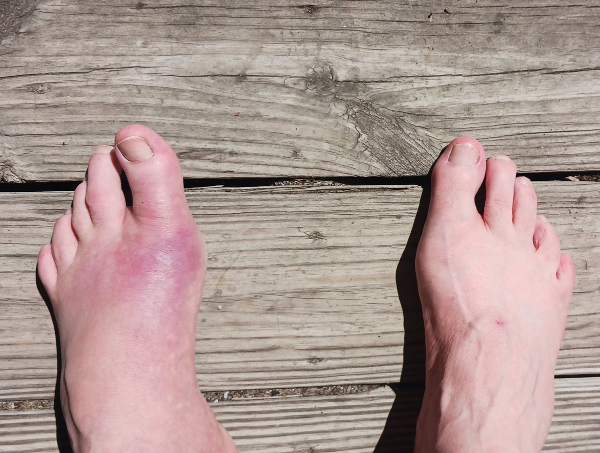 ErikFredrickson's tweet photo. The importance of your diet in your later years can't be stressed enough. Gout is easily the most painful thing that's ever happened to me. That and watching Dean Cain try to stay relevant. https://t.co/d50m44qlqR