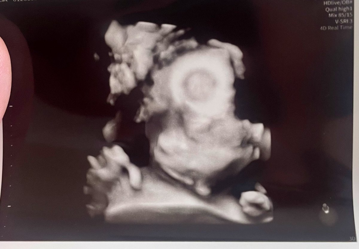R712bab's tweet photo. 22w6dで初のお顔👶
骨盤の下に隠れてて正面からは見えなかったけど、先生が色んな角度から見せてくれた。

お顔が見えると実感もわく
この子のために安静にして入院頑張らなきゃ

 #エコー写真 https://t.co/ob5ZXB4lNN