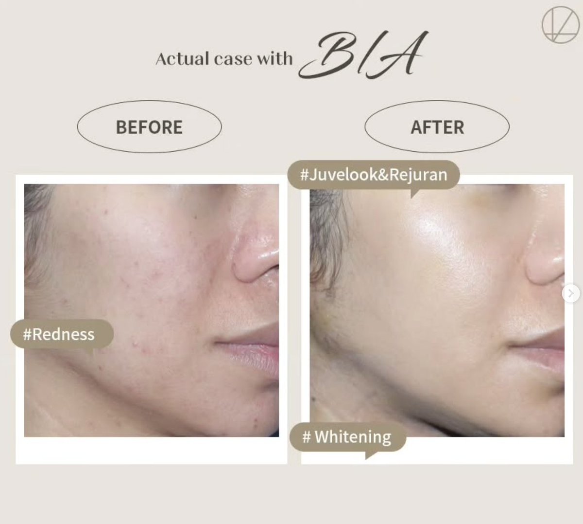 【人気スキンブースター4選💉✨】
▶️ ジュベルック：コラーゲン生成で自然なハリ
▶️ リジュラン：PNで肌再生＆弾力UP
▶️ エクソソーム：ダメージ肌の修復に◎
▶️ ポテンツァ：毛穴・ニキビ・小ジワに効果的

肌悩みに合わせてカスタマイズ❣️
📩カウンセリング受付中！