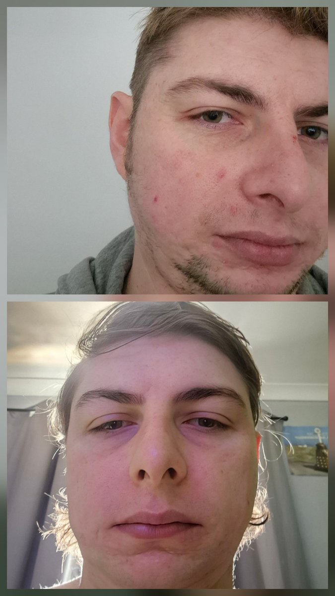 3 weeks on HRT starting to see slightly changes 😁
#twitchsmallstreamer #gaming #SmallStreamerCommunity #trans #youtubegaming #youtube