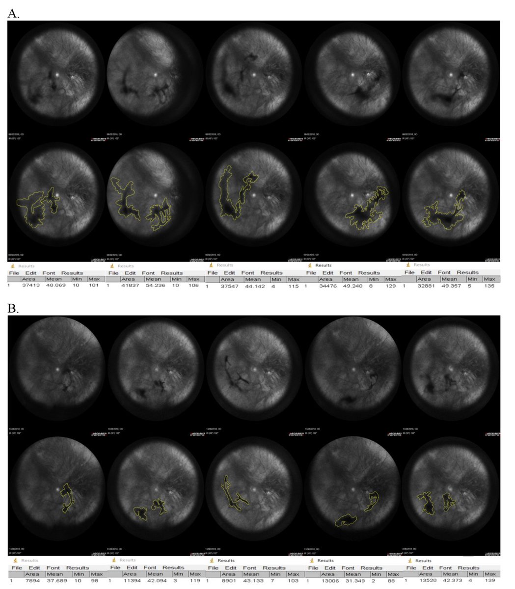 Outdoctrination's tweet image. Here's a visualization of what the supplement did.

On the top (A) is one individual before the study.

The bottom (B) is them after 6 months of the supplement.

(7/8)
