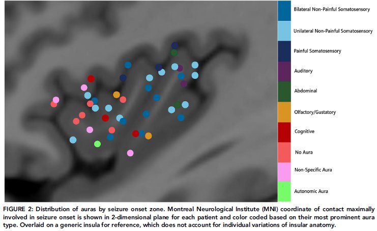 Jason Chisholm (@epildoc27) on Twitter photo Thrilled to share our publication in <a href="/ANA_journals/">ANA Journals</a> on insular epilepsy, a cause of surgical failures in epilepsy.
We characterized the seizure semiology of the largest SEEG-confirmed cohort to date. #epilepsy
Details: doi.org/10.1002/ana.70… Thrilled to share our publication in <a href="/ANA_journals/">ANA Journals</a> on insular epilepsy, a cause of surgical failures in epilepsy.
We characterized the seizure semiology of the largest SEEG-confirmed cohort to date. #epilepsy
Details: doi.org/10.1002/ana.70…