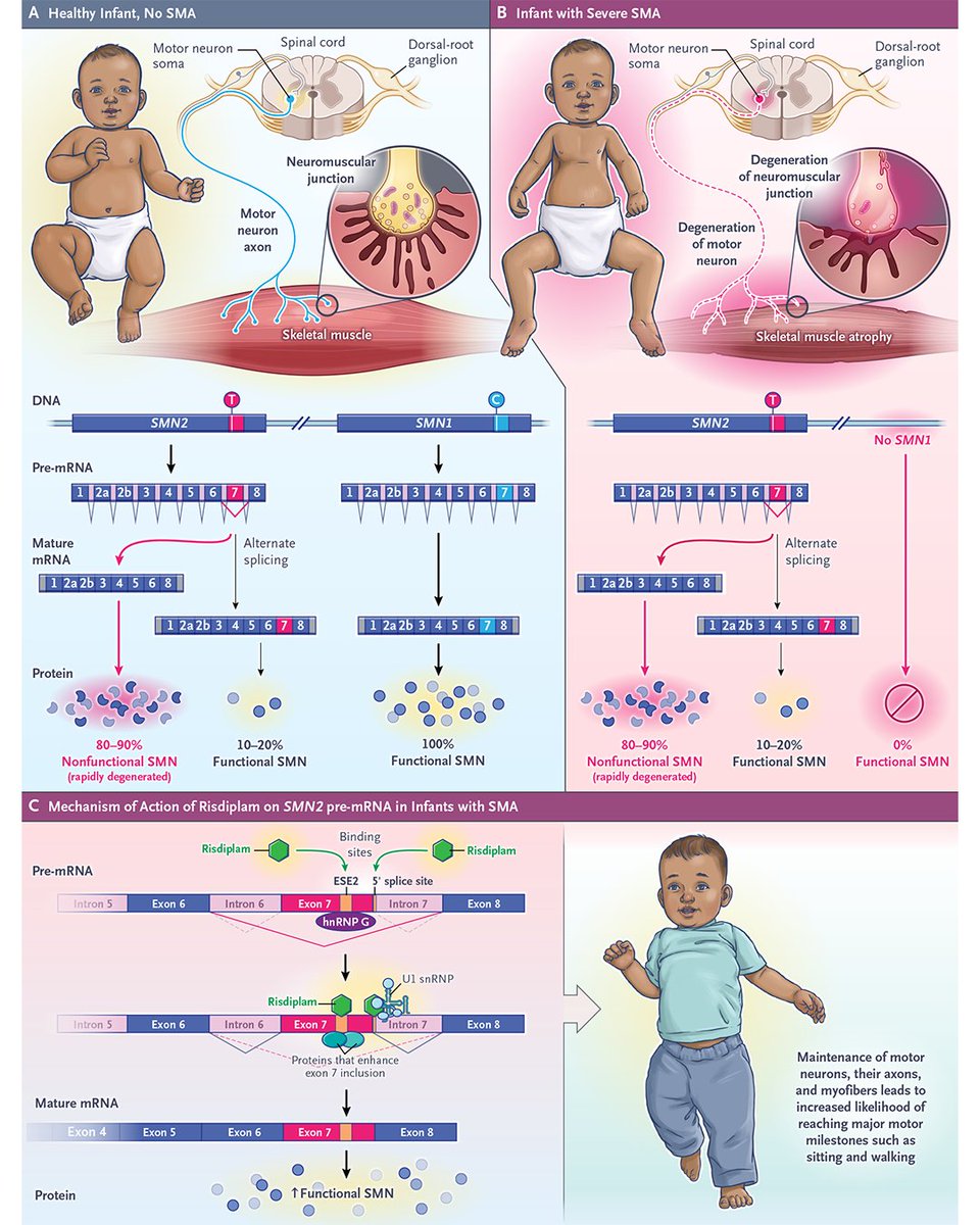 Science behind the Study: Presymptomatic Treatment of a Genetic Disease with a Small-Molecule Drug nej.md/46ORJrO 

#Neurology #Genetics