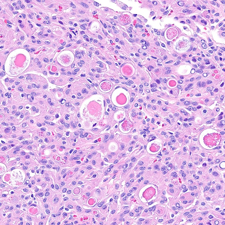What subtype of meningioma is this? (If you know, keep it to yourself, it's a SECRET.) #pathology #neuropath #PathTwitter