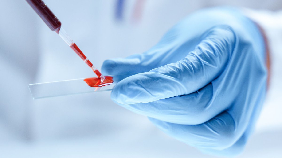 AmerGastroAssn's tweet image. 📉 #CRC remains a top cause of cancer death, yet screening rates stay low. 

Get the latest insights in our new clinical practice update published in @AGA_CGH.

📰 Read more: ow.ly/I5n350WFA4f

@priyanka_kanth @AasmaShaukatMD 

#GItwitter