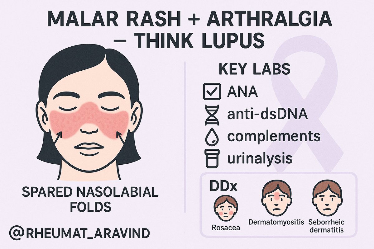 🌸 Malar rash + joint pain?
Think Lupus.
Check: ANA ✅, anti-dsDNA 🧬, complements 💧, urinalysis 🧪.
Don’t miss the differentials — rosacea, dermatomyositis, seborrheic dermatitis.
Early diagnosis = better outcomes. #MedTwitter #LupusAwareness <a href="/IhabFathiSulima/">Dr Ihab Suliman</a> <a href="/DrAkhilX/">Dr. Akhil 🇮🇳</a>