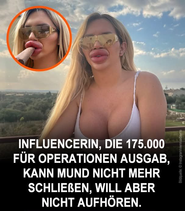 DirtyHarry_tv's tweet photo. Vienna Würstel, eine 25-jährige trans Influencerin, die auf Mallorca (🇪🇸) lebt, hat mehr als 175.000 USD in Schönheitsoperationen investiert – davon allein 50.000 USD für Lippenaufspritzungen. Ihre Lippen sind inzwischen so stark vergrößert, dass sie ihren Mund nicht mehr normal schließen kann und Schwierigkeiten hat, durch die Nase zu atmen. Doch diese Transformation, die begann, als sie 18 war, scheint kein Ende zu haben – im Gegenteil: Sie sagt, sie habe nicht vor, aufzuhören.

💉 Die junge Frau reist regelmäßig nach Frankfurt (🇩🇪), um sich bei ihrem vertrauten Chirurgen neue Hyaluronsäure spritzen zu lassen. Jede Sitzung kostet über 2.000 USD, und ihr Ziel ist es, im nächsten Jahr 200 cc Lippenvolumen zu erreichen. Derzeit hat sie 93 cc und lässt alle zwei bis vier Wochen nachspritzen. Laut ihr sind große Lippen entscheidend, um sich s3xy zu fühlen. 💬 „Für mich sind große Lippen der ultimativ feminine und sexy Look“, sagte sie selbstbewusst.

Obwohl sie in den sozialen Medien Kritik und gesundheitliche Probleme erlebt, sagt sie, dass sie mit ihrer Transformation glücklich ist. 💬 „Mein Hals schmerzt morgens, weil ich nun dank meiner Lippen ständig den Mund offen habe“, erklärte sie. Trotzdem fühlt sie sich von ihrer Familie, ihren Freunden und ihrem Partner unterstützt. „Es lohnt sich absolut“, stellte sie klar.