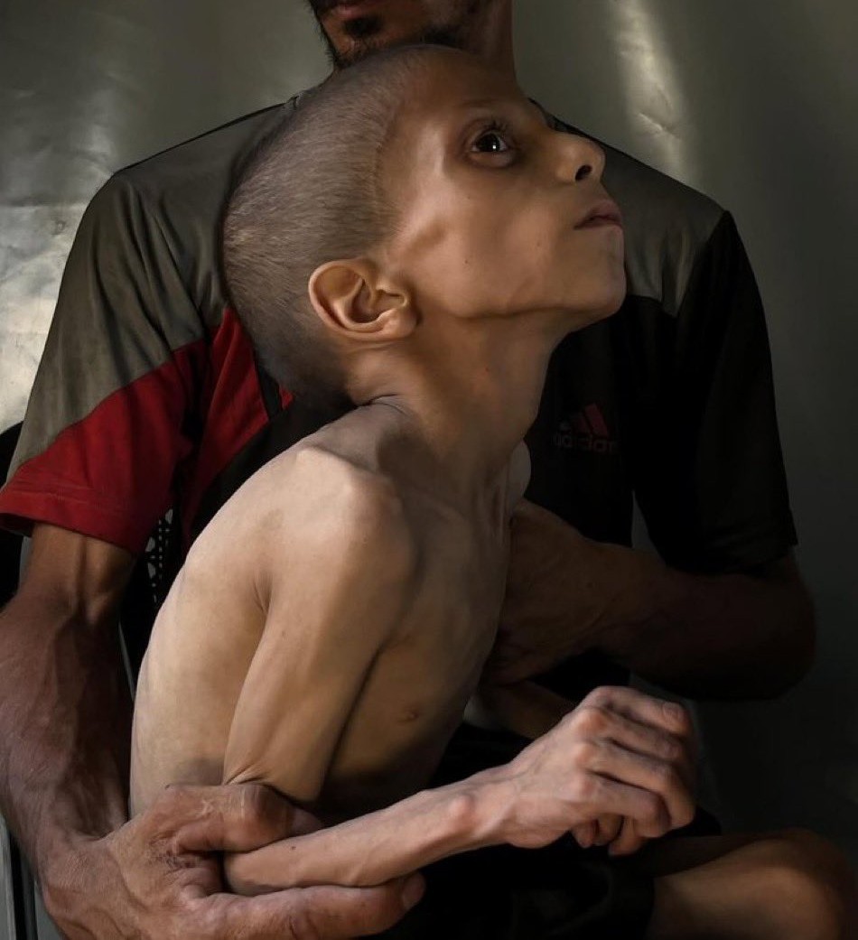 الجوع في غزة لا يسرق فقط طعام الأطفال، بل يسرق ذاكرتهم، فيفقدون القدرة على تذكر أبسط الأشياء، وكأن عقولهم تتلاشى مع كل وجبة تُفوّت. أجسادهم الرقيقة تتحول إلى هياكل عظمية هشّة، تعاني من قسوة الجوع ، حيث يتآكل جسد الطفل كما تتآكل آماله، تاركًا وراءه صورة موجع تُكافح من أجل البقاء.