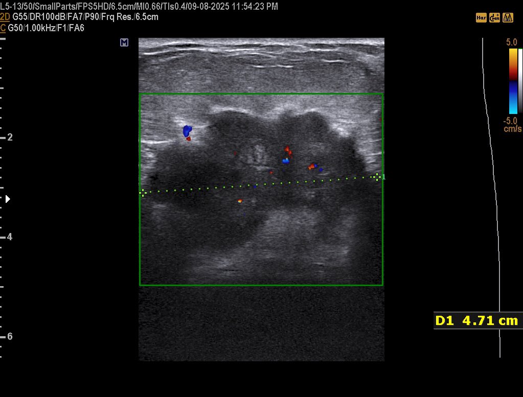 EchoTech_4's tweet image. 42 years female presented with a palpable painless hard and fixed Breast mass since 1 year

BI-rads?

#EchoTech @ABCDEcografia @dmiguelmolina @Omkolsoumyahoo1