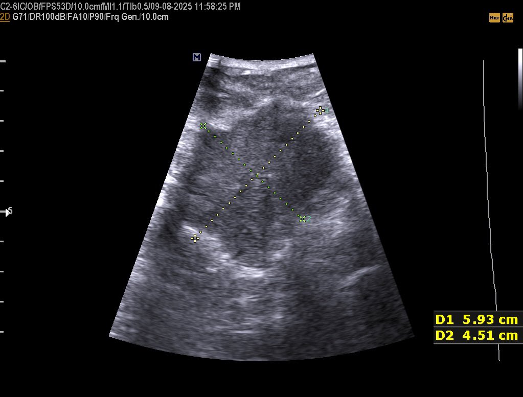 EchoTech_4's tweet image. 42 years female presented with a palpable painless hard and fixed Breast mass since 1 year

BI-rads?

#EchoTech @ABCDEcografia @dmiguelmolina @Omkolsoumyahoo1