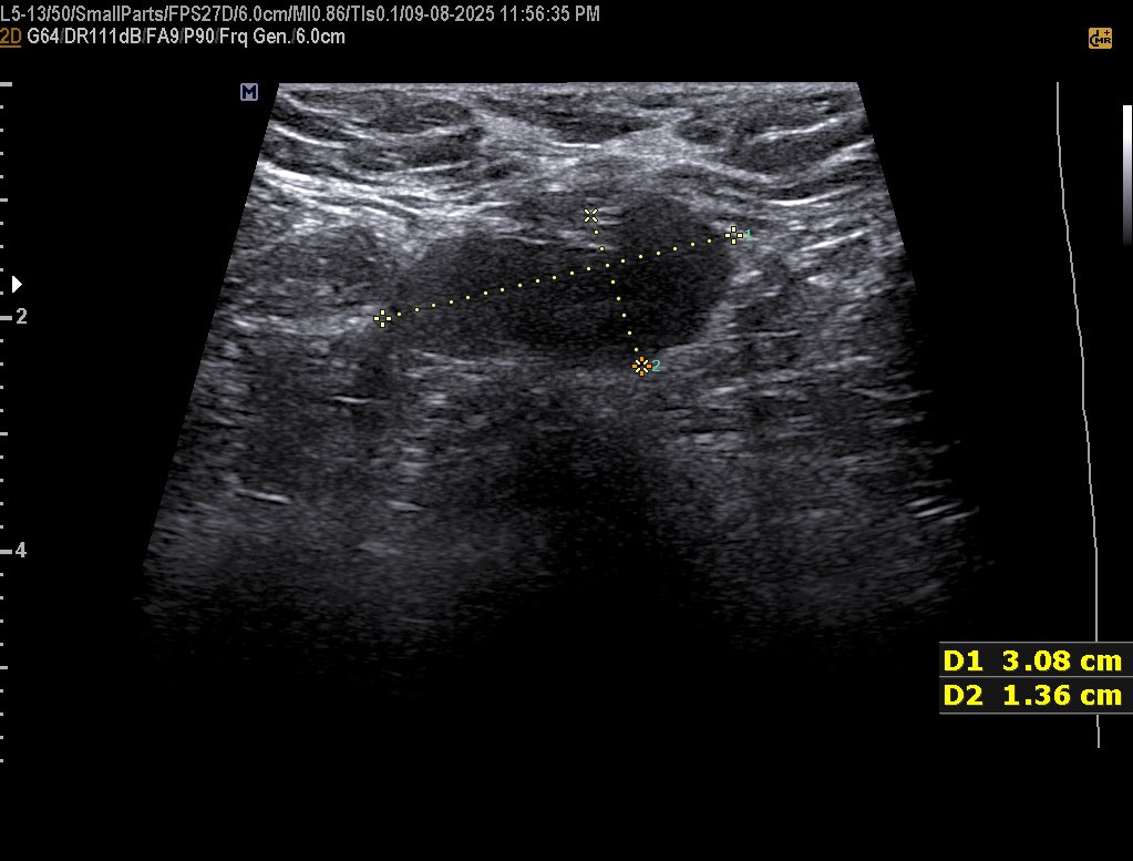 EchoTech_4's tweet image. 42 years female presented with a palpable painless hard and fixed Breast mass since 1 year

BI-rads?

#EchoTech @ABCDEcografia @dmiguelmolina @Omkolsoumyahoo1