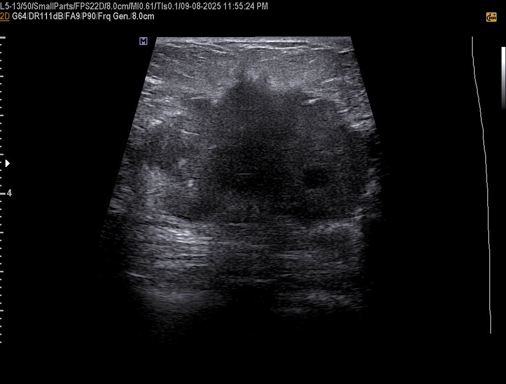 EchoTech_4's tweet image. 42 years female presented with a palpable painless hard and fixed Breast mass since 1 year

BI-rads?

#EchoTech @ABCDEcografia @dmiguelmolina @Omkolsoumyahoo1