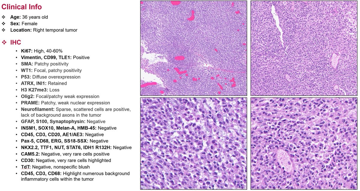 Methylation Case of the Week:   

36 year old female patient with a right temporal tumor. Glial markers are generally negative. it Can be dIfficult to properly diagnose this Case, however the Simplicity of the morphology And the Round Cell features can help.  #PathTwitter