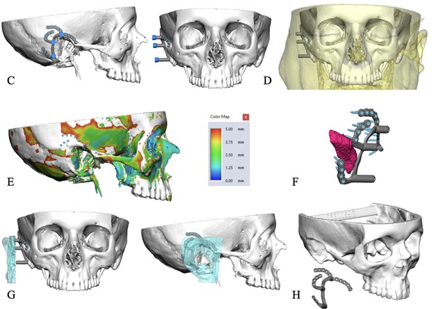 New publication in ANZ Journal of Surgery:
A novel subperiosteal implant technique for ear reconstruction after major cancer surgery—promising early results with strong function &amp; aesthetics.

👉Read Here: buff.ly/XObdGUe
#SurgicalInnovation #CancerCare