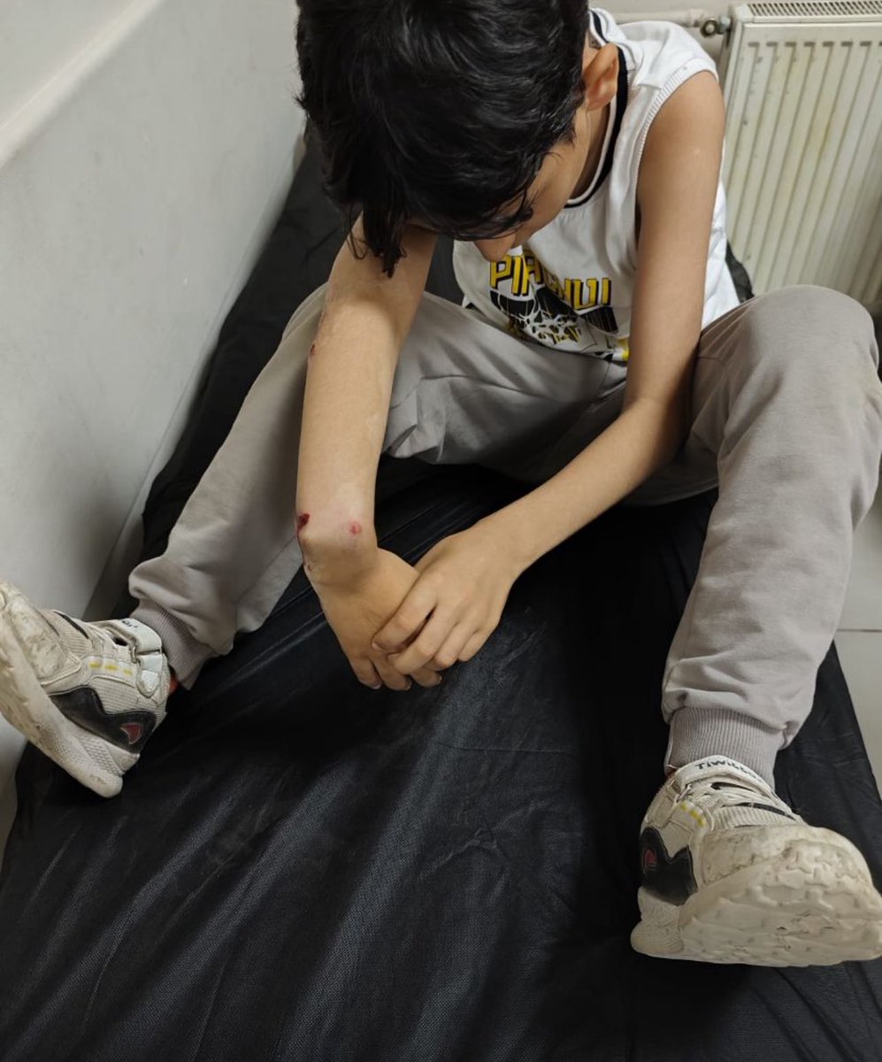 Polis eşinin eline çarptım, polis ceza olarak bileğimi kırdı.

Fotoğraftaki kırık bilek benim bileğim. 
Ben E.  9 yaşındayım. Hakkariliyim.

Sokakta bisiklet sürerken yanlışlıkla bir kadının eline çarptım. Kadının eşi polismiş.

Polis geldi ve benim bileğimi kırdı. Kemiğim