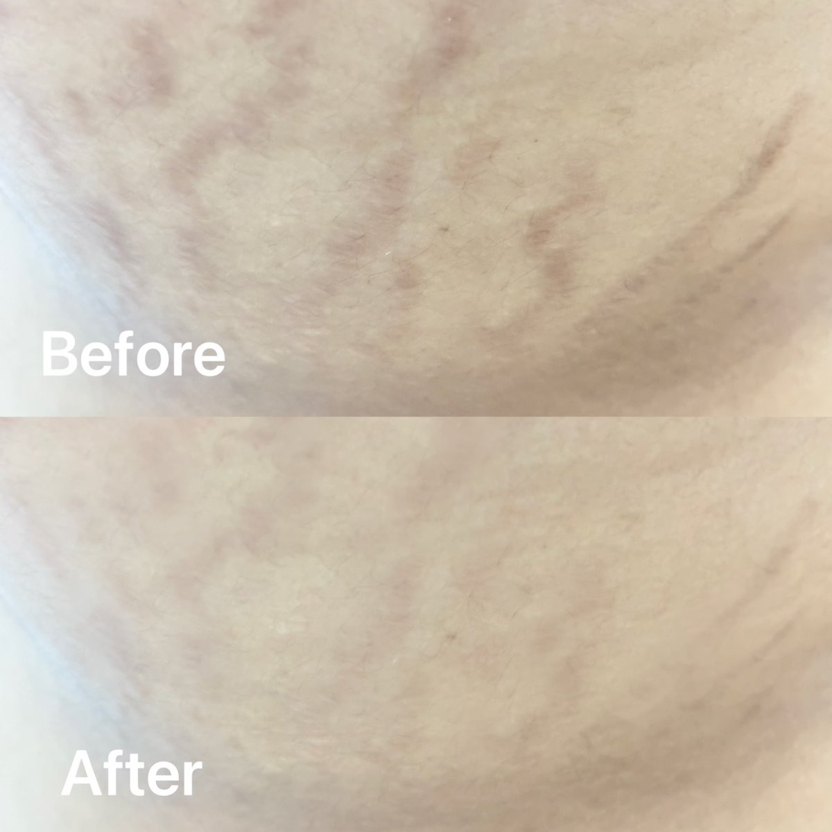 “อย่ารอให้รอยแตกฝังแน่น รีบใช้ก่อนผิวจะพัง”รอยแตกลาย เซรั่มลดรอยแตกลายจากญี่ปุ่น ทาเช้า-เย็นหลังอาบน้ำ เนื้อบางเบา ซึมไว ไม่เหนียว
✅ ขวดใหญ่ ใช้นาน
✅ ทาแล้วผิวเนียนขึ้น รอยจางไว
✅ ช่วย ท้อง ขา สะโพก
 ใช้จริง กล้าบอกต่อ ไปตำกัน
#เซรั่มลดรอยแตกลาย  #ใช้จริงรีวิวจริง #CocoroTokyo