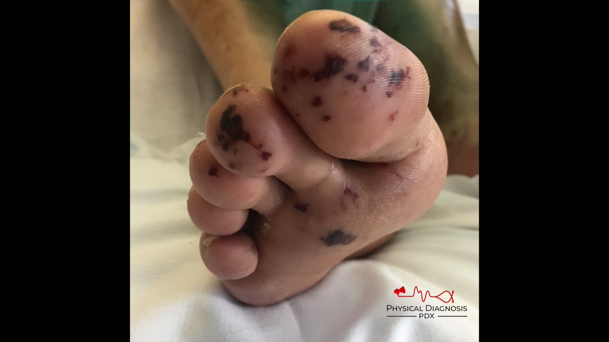1/7
A young man is admitted to the hospital with malaise and fever. There are tender nodules on his palms as well as non-tender macular lesions on the soles of his feet.

These findings should generate a hypothesis.