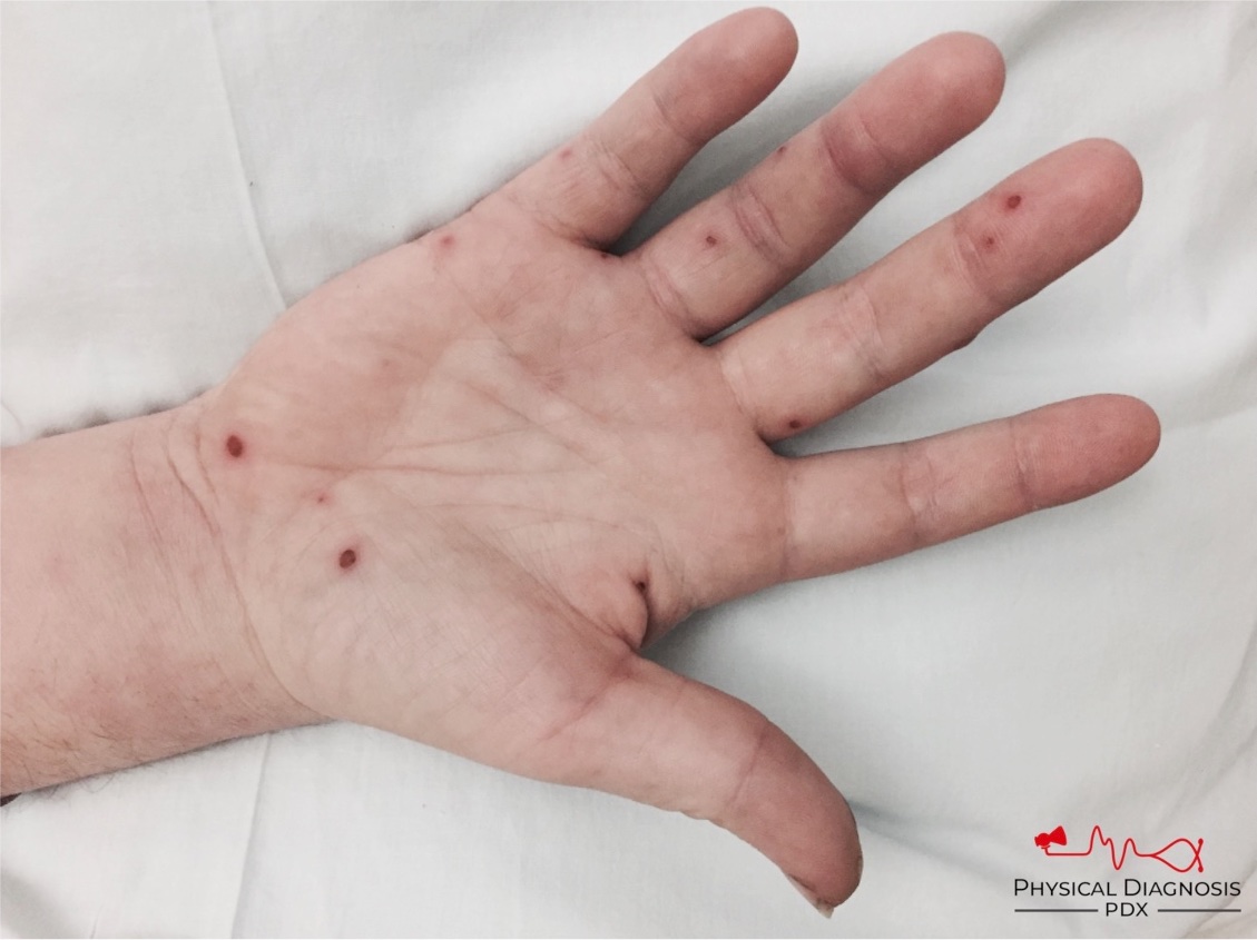 AndreMansoor's tweet photo. 1/7
A young man is admitted to the hospital with malaise and fever. There are tender nodules on his palms as well as non-tender macular lesions on the soles of his feet.

These findings should generate a hypothesis. https://t.co/RV4NfGafff