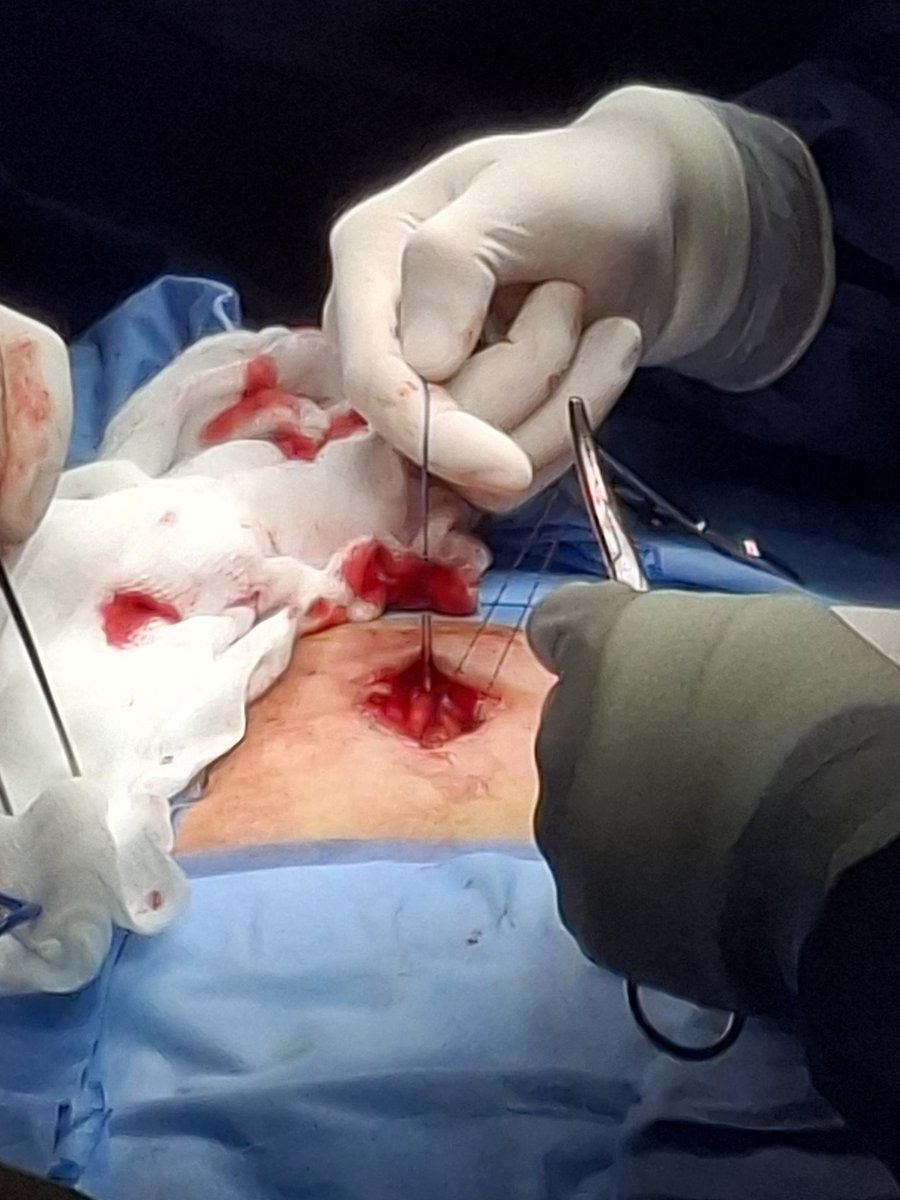 DrJAVazquez's tweet photo. Enseñemos a nuestros Rs que mínimamente invasivo no siempre es igual a laparoscopía y que #LaParedImporta #SoMe4Surgery #SoME4IQLatAm #surgicalmentor https://t.co/aeqRNq7ZzF