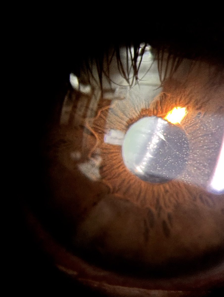Flare &amp; Cells – Uveitis Pearls 🔍👁️

1️⃣ Cells = active inflammation

2️⃣ Flare = protein leak from B–A barrier

3️⃣ Grade separately (SUN scale)

4️⃣ Flare may persist after cells → chronicity

5️⃣ Heavy flare + fibrin → risk of synechiae

#Ophthalmology #Uveitis #MedTwitter