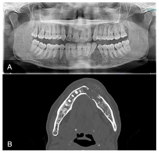 📢 Feel free to read our recent publication:

Oral Rehabilitation Following Surgical Treatment of Mandibular Ameloblastoma: Case Report and Comprehensive Literature Review mdpi.com/3440882 

👨‍🔬 by Sepideh Goudarzi et al. 

🏫 <a href="/UniversitdiPisa/">Università di Pisa</a> 

<a href="/Oral_MDPI/">Oral MDPI</a>