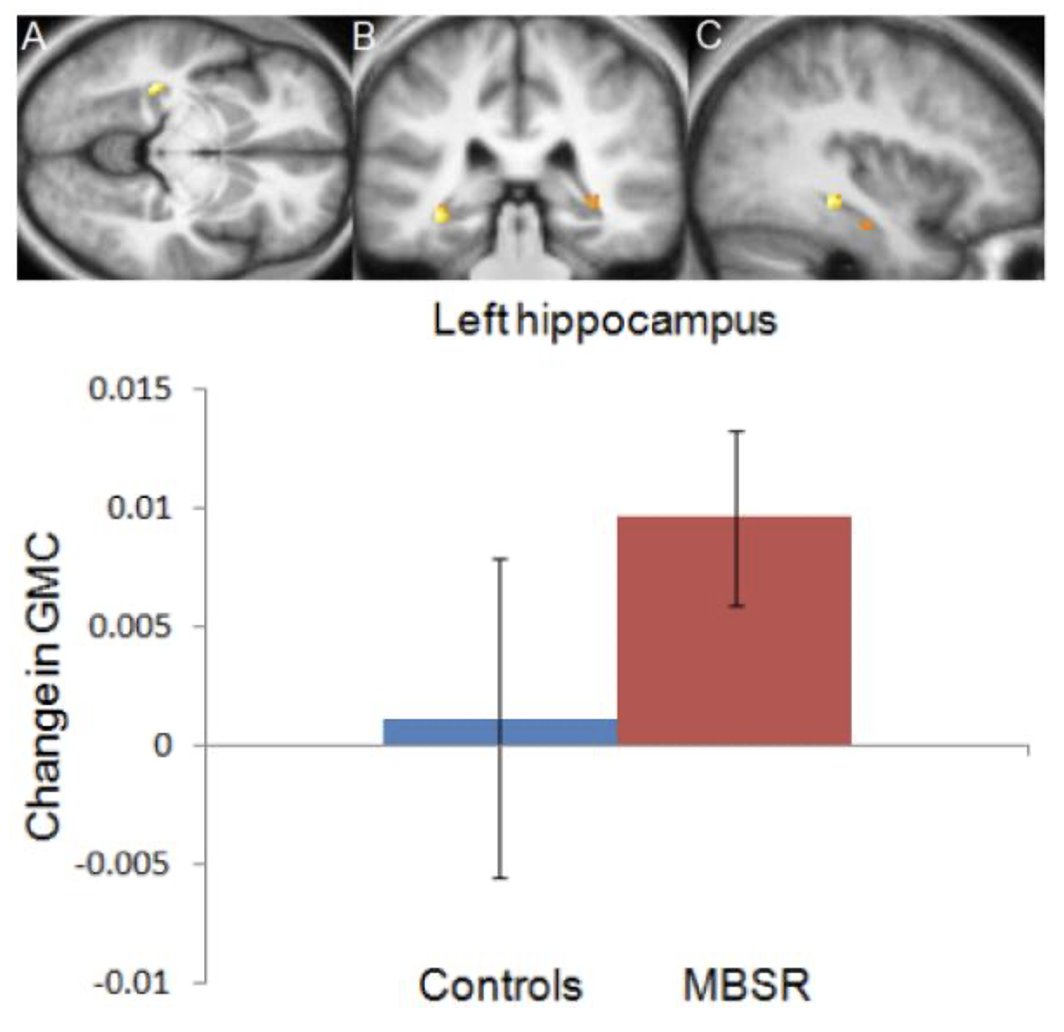 Eight weeks of mindfulness training was associated with increased hippocampal gray-matter concentration on MRI.

Presence can remodel biology.