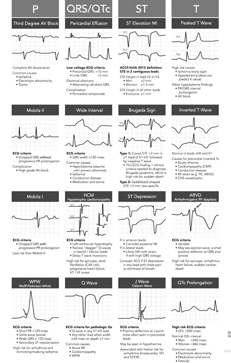 Deadly ECG Patterns