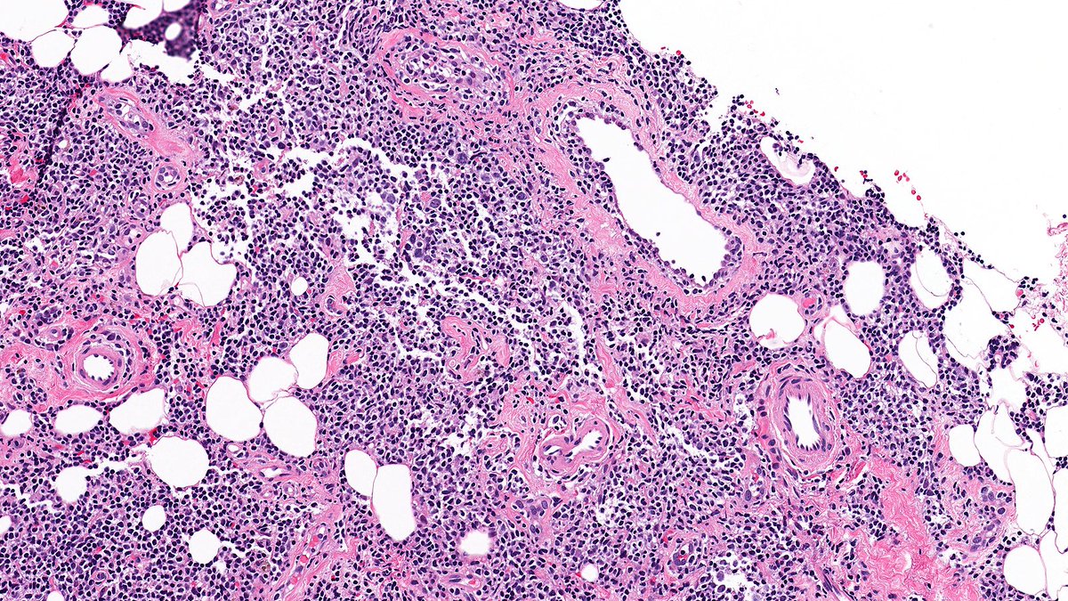 What’s this breast lesion? 🔬

Cast your vote below 👇

Answer revealed Monday!

#PathX #PathTwitter #breastpath #PathQuiz