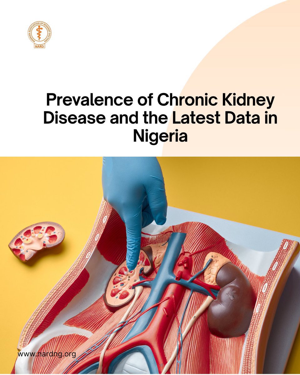 nard_nigeria's tweet photo. Prevalence of Chronic Kidney Disease and the Latest Data in Nigeria....... 

National Estimate (Meta‑Analysis)

A 2023 meta-analysis of 10 community-based studies on 7,010 Nigerians found chromic kidney disease prevalence at approximately15.4% and further analysed that, about 17.8 million adults are living with the condition.

Regional Variability

Population based studies in Nigeria show chronic kidney disease rates ranging from 2.5% up to 26%, depending on region and measurement method.
 
 Kwara State Urban Survey

 A study among approximately 1,350 urban adults in Kwara (North-Central Nigeria) found age-adjusted chronic kidney disease prevalence of 12%, defined by eGFR <60 ml/min or proteinuria. Risk factors were mostly diabetes, obesity, proteinuria, older age, female sex.
 
Rural Anambra State Community Data

 In rural Anambra, a community survey of approximately 391 persons reported chronic kidney disease prevalence of 10.7% while 6.6% had reduced kidney function; 7.9% had albuminuria.

Why It Matters

 Chronic kidney disease often progresses silently. Most don't know until late stages.
 About 90% of dialysis patients in Nigeria die within 3 months if unresolved.
 Major risk factors include hypertension, diabetes, obesity, and herbal remedy misuse.
 
What You Can Do

 -Get screened if you have high blood pressure, diabetes, or obesity.
 -Ask for kidney function tests.
 -Maintain healthy lifestyle, limit herbal mixtures or NSAIDs without prescription.