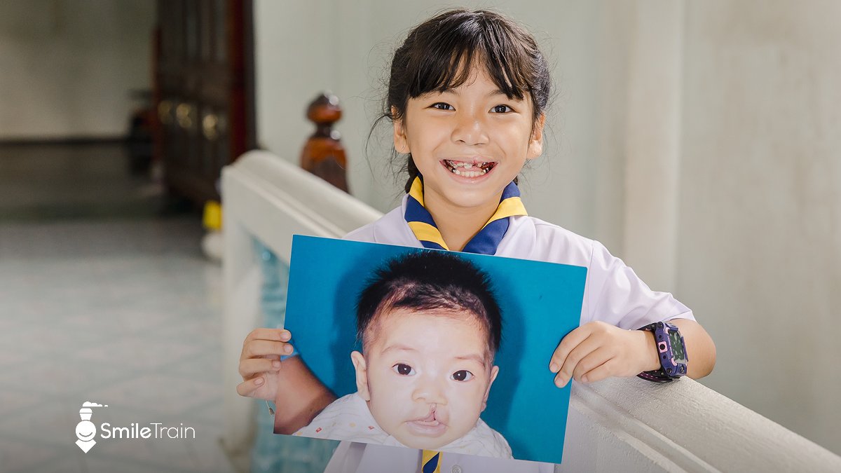 Smile Train UK (@smiletrainuk) on Twitter photo Smile Train’s journey in Thailand continues!
Since 2001, we've supported 5,400+ cleft surgeries for families who couldn’t otherwise afford them. With 20+ partner surgeons and eight treatment centres across the country, we’re unlocking our patients' potential, one smile at a time. Smile Train’s journey in Thailand continues!
Since 2001, we've supported 5,400+ cleft surgeries for families who couldn’t otherwise afford them. With 20+ partner surgeons and eight treatment centres across the country, we’re unlocking our patients' potential, one smile at a time.